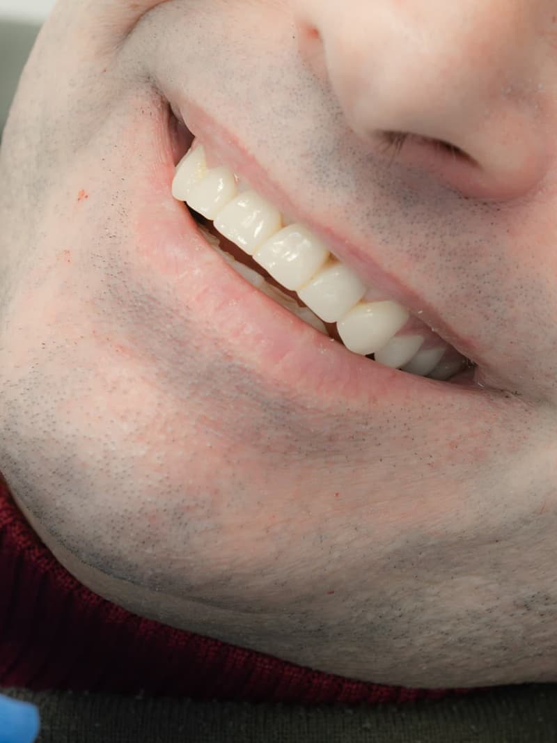 Haz brillar tu sonrisa con un blanqueamiento dental en Redondela