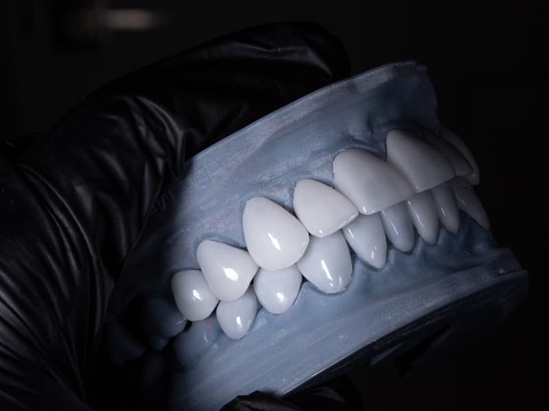 Carillas de zirconio