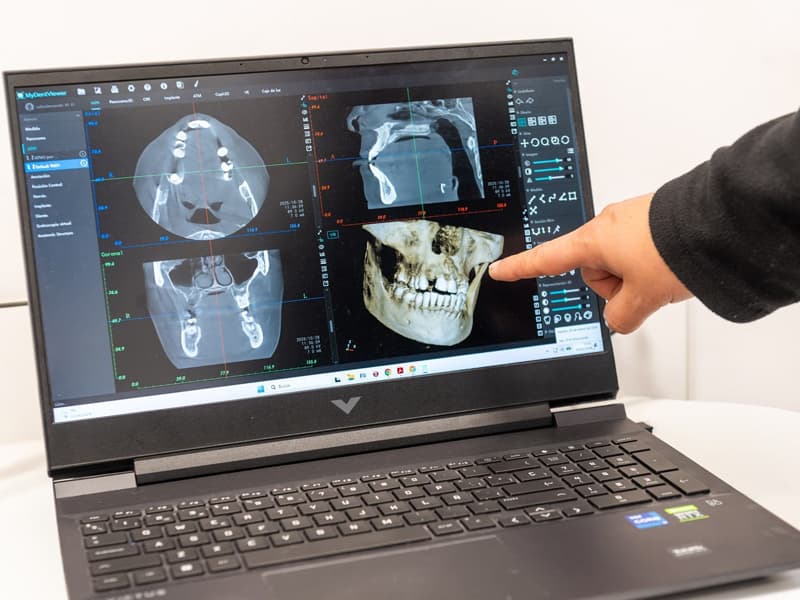 Implantología en Redondela