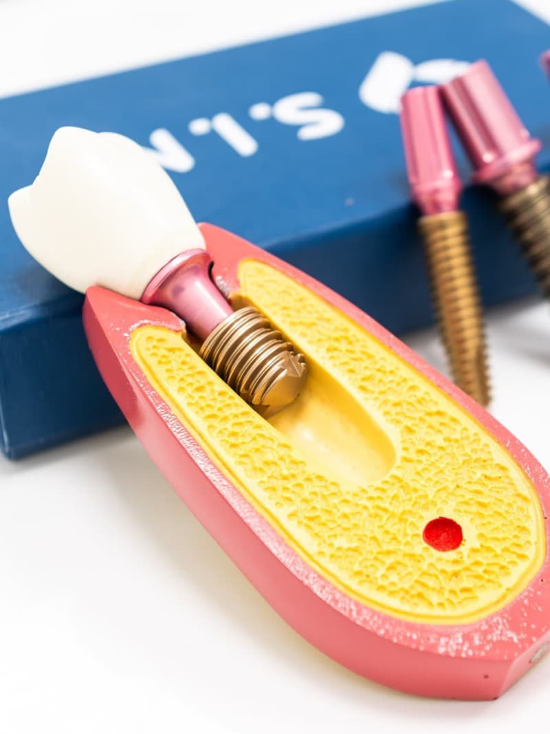 Implantes dentales en Redondela
