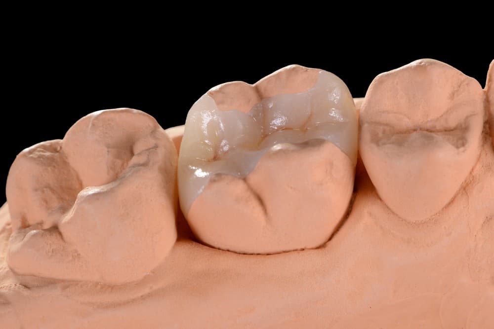 Diseñamos tus incrustaciones dentales con odontología digital