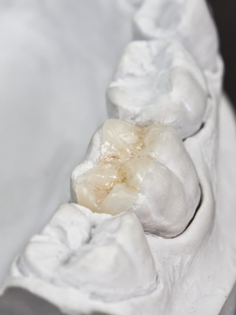 Expertos en incrustaciones dentales en Redondela