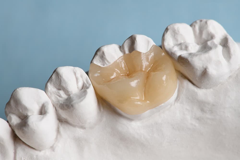 Perfecciona tu sonrisa con nuestras carillas dentales en Redondela